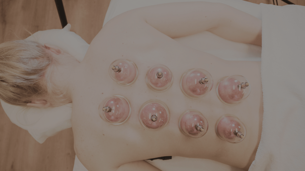 Cupping-behandling med vakuumkopper på ryggen af klient hos SUNDby Sportsmassage i Nykøbing Falster.